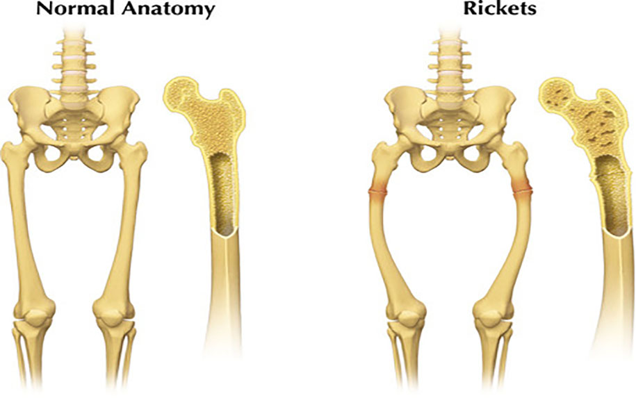 راشیتیسم یا پای پرانتزی و درمان آن